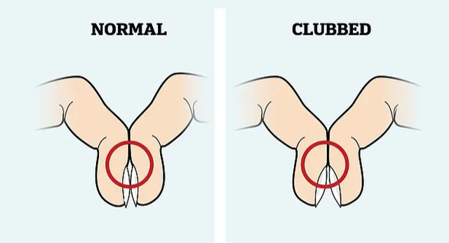 cach-kiem-tra-ngon-tay-don-gian-de-biet-lieu-ban-co-bi-ung-thu-phoi-khong-1575246862423
